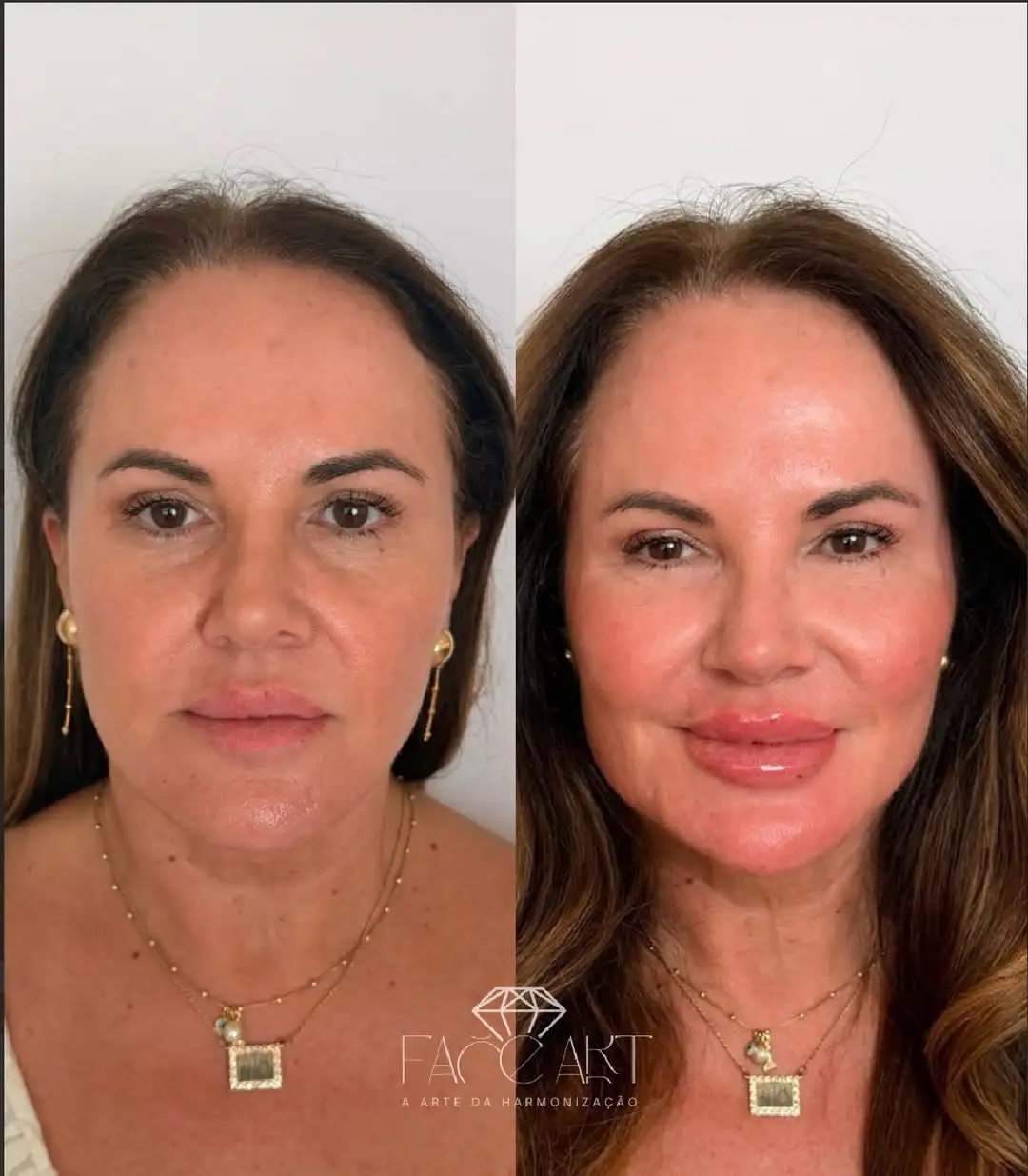 Harmonização facial e Full Face na Clínica Auge para pacientes de Itaúna e Pará de Minas